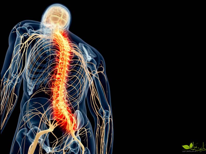 نوروپاتیک کانونی